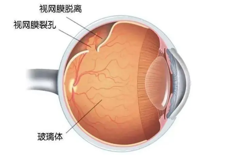 警惕视网膜脱离的4个征兆