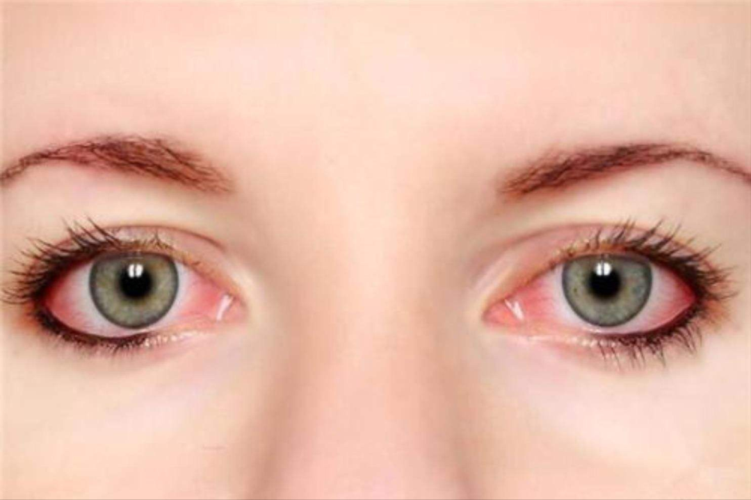 呵护明眸，防癌又健康：深入探索眼睛异常与营养守护